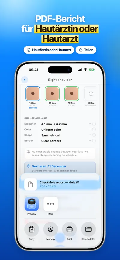 Screenshot der CheckMole-iOS-App
