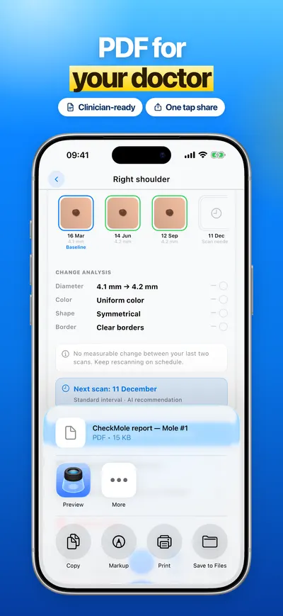 CheckMole iOS app screenshot