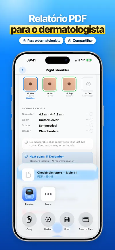 Captura de tela do app CheckMole para iOS