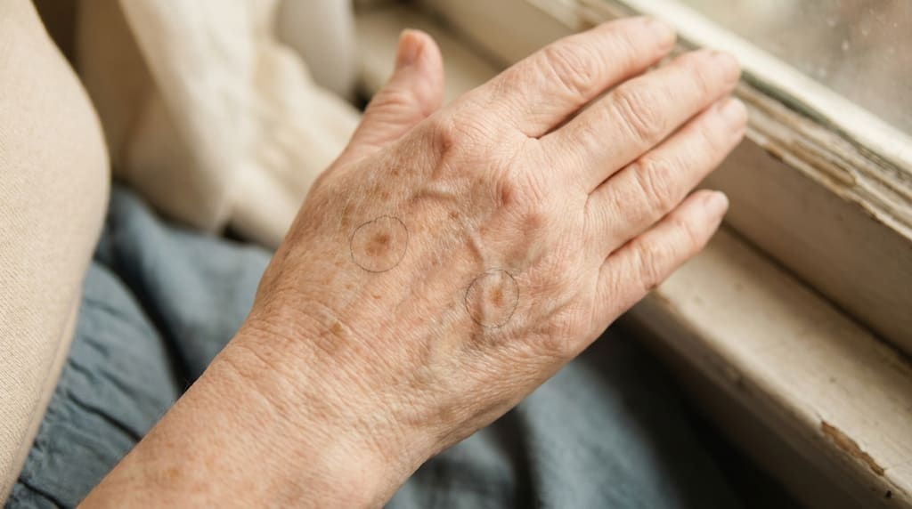 Macro close-up of two skin spots on a mature person's hand